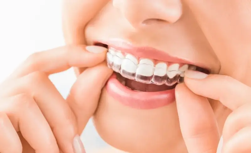 Invisalign dla dzieci
