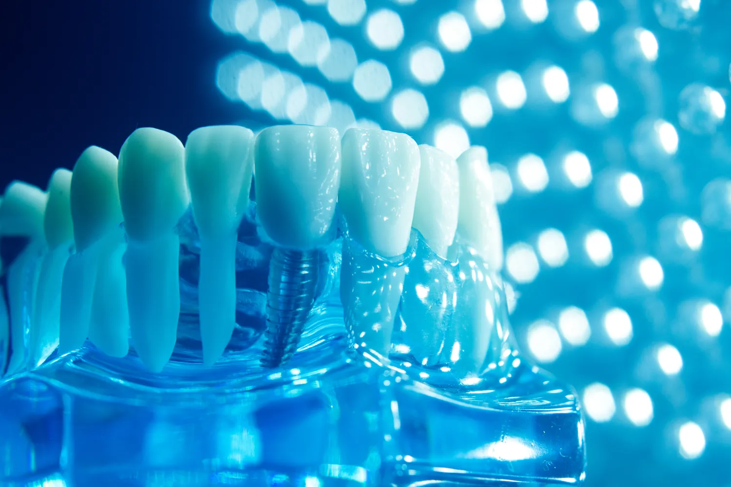 Implanty Warszawa gdzie najlepiej?