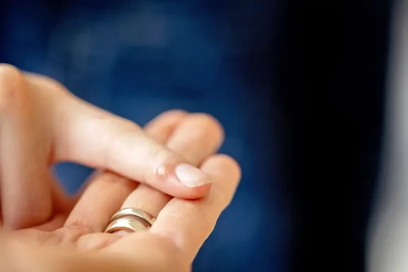 Jak domowym sposobem pozbyć się kurzajki?